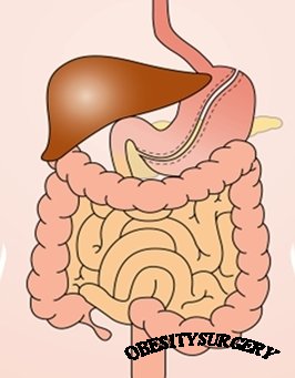 Продольная резекция желудка («Sleeve gastrectomy»)