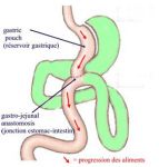 Мини шунтирование желудка (Mini gastric bypass, MGB)