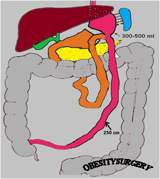 Лапароскопічне дистальне шунтування шлунка з одним анастомозом